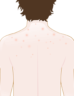 boutons sur la nuque