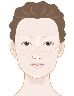 Taches de rousseur ? - réduit les taches de rousseur et unifie le teint de la peau