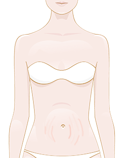 des vergetures sur les seins