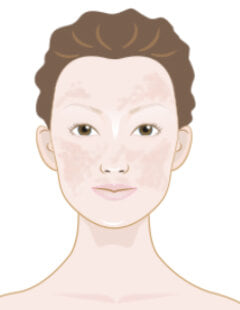 Hyperpigmentation 