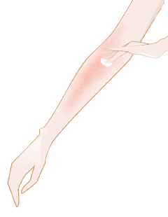 coup de soleil