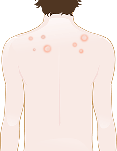 infection fongique