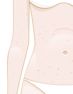 varicelle
