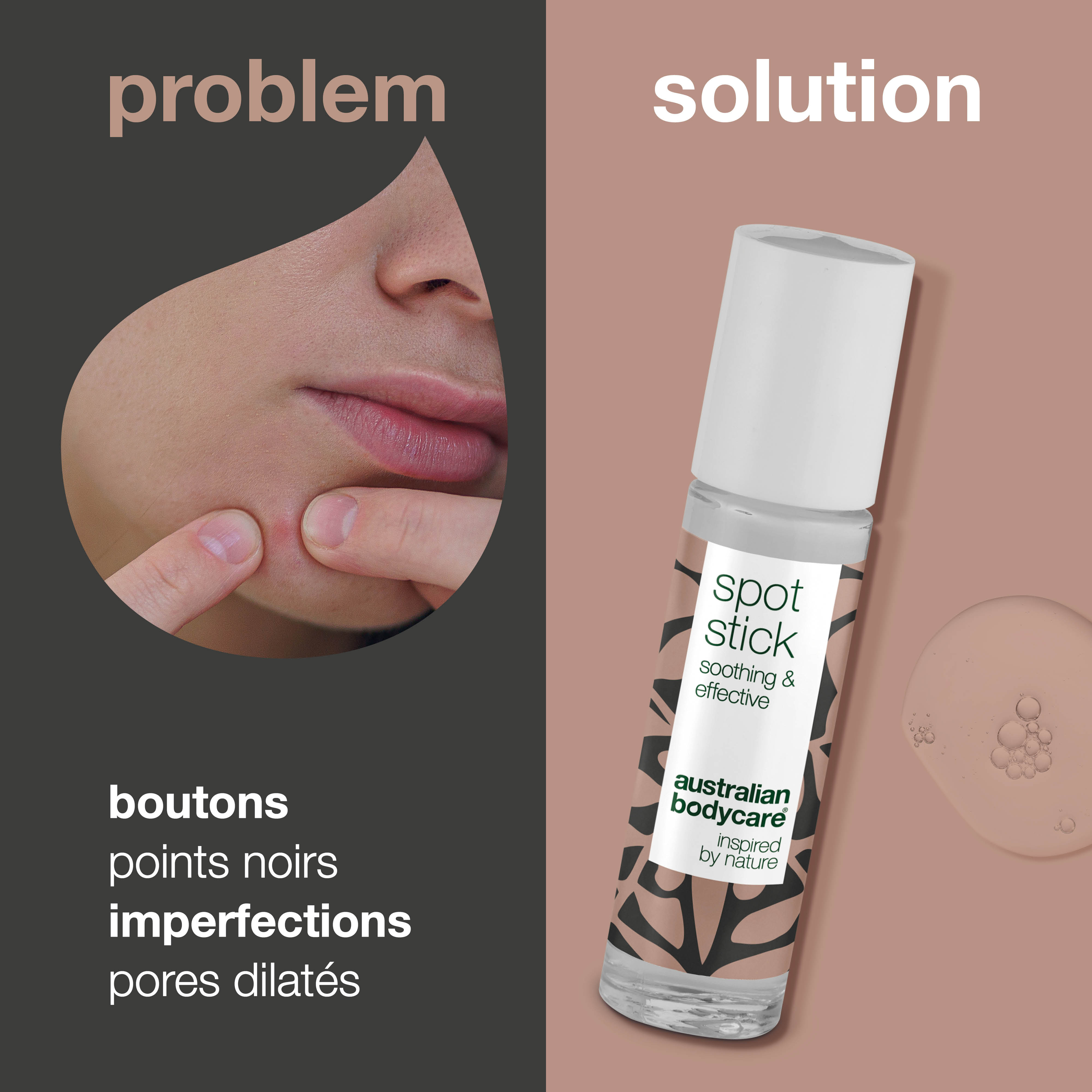 Traitement localisé à l'huile d'arbre à thé pour peaux congestionnées — pour le soin quotidien de l'acné et efficace contre les peaux à imperfections, les boutons et les points noirs.