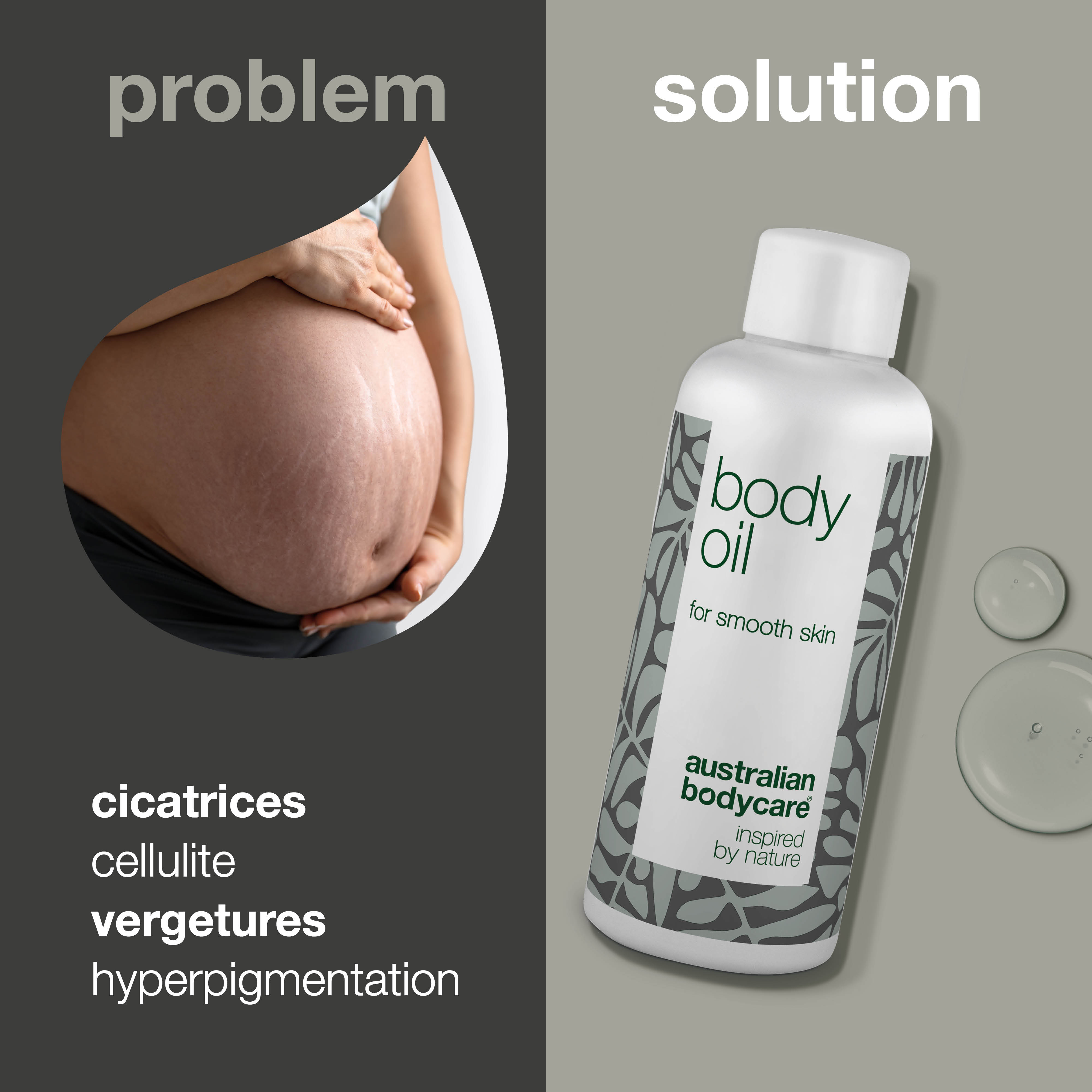 Huile corporelle pour vergetures, cellulite et cicatrices — Réduit l’apparence des vergetures, de l’hyperpigmentation, des cicatrices et de la peau d’orange