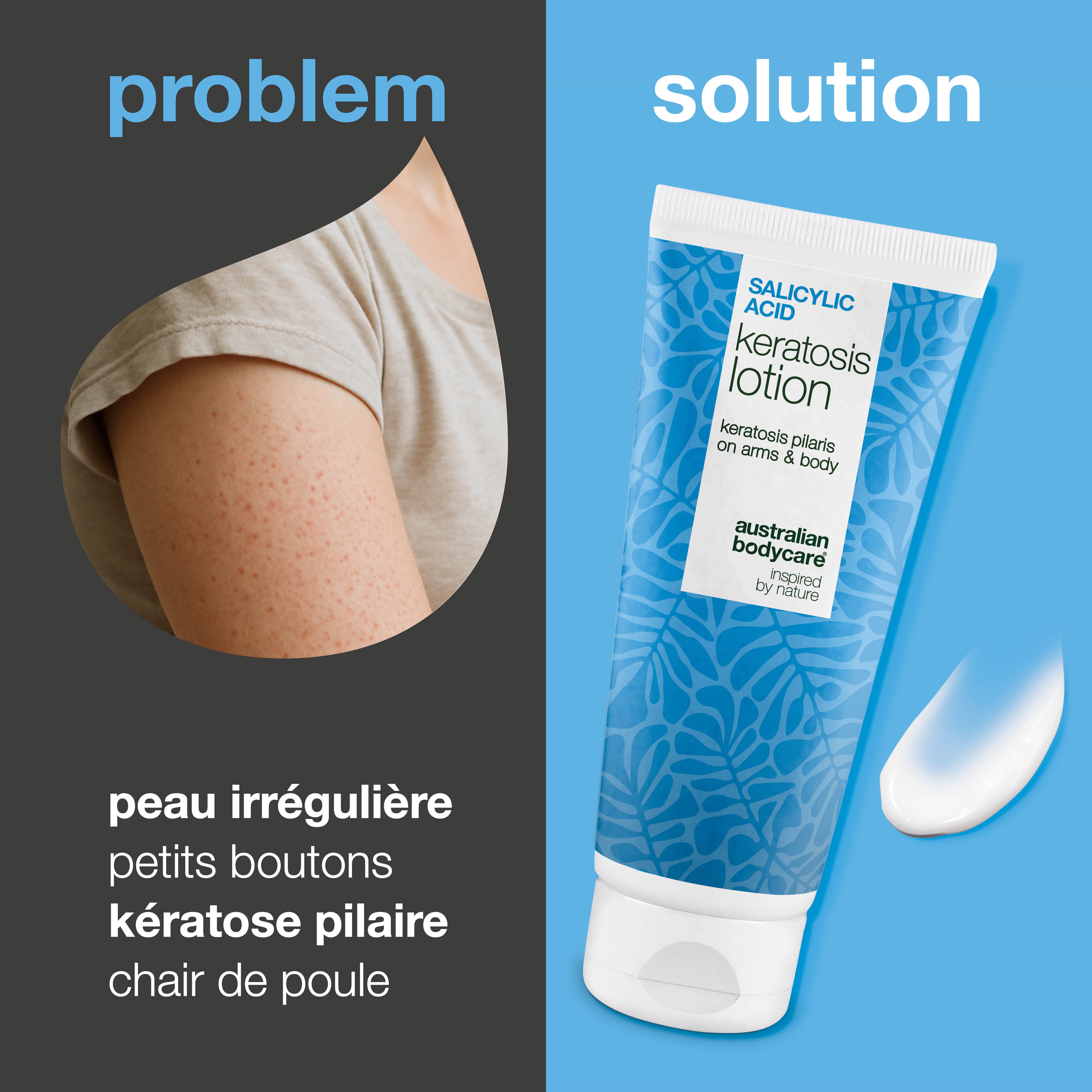 Lotion corps kératose pilaire et peau sèche granuleuse — Lotion pour kératose pilaire et peau sèche. Lisse avec acide salicylique, niacinamide et zinc.