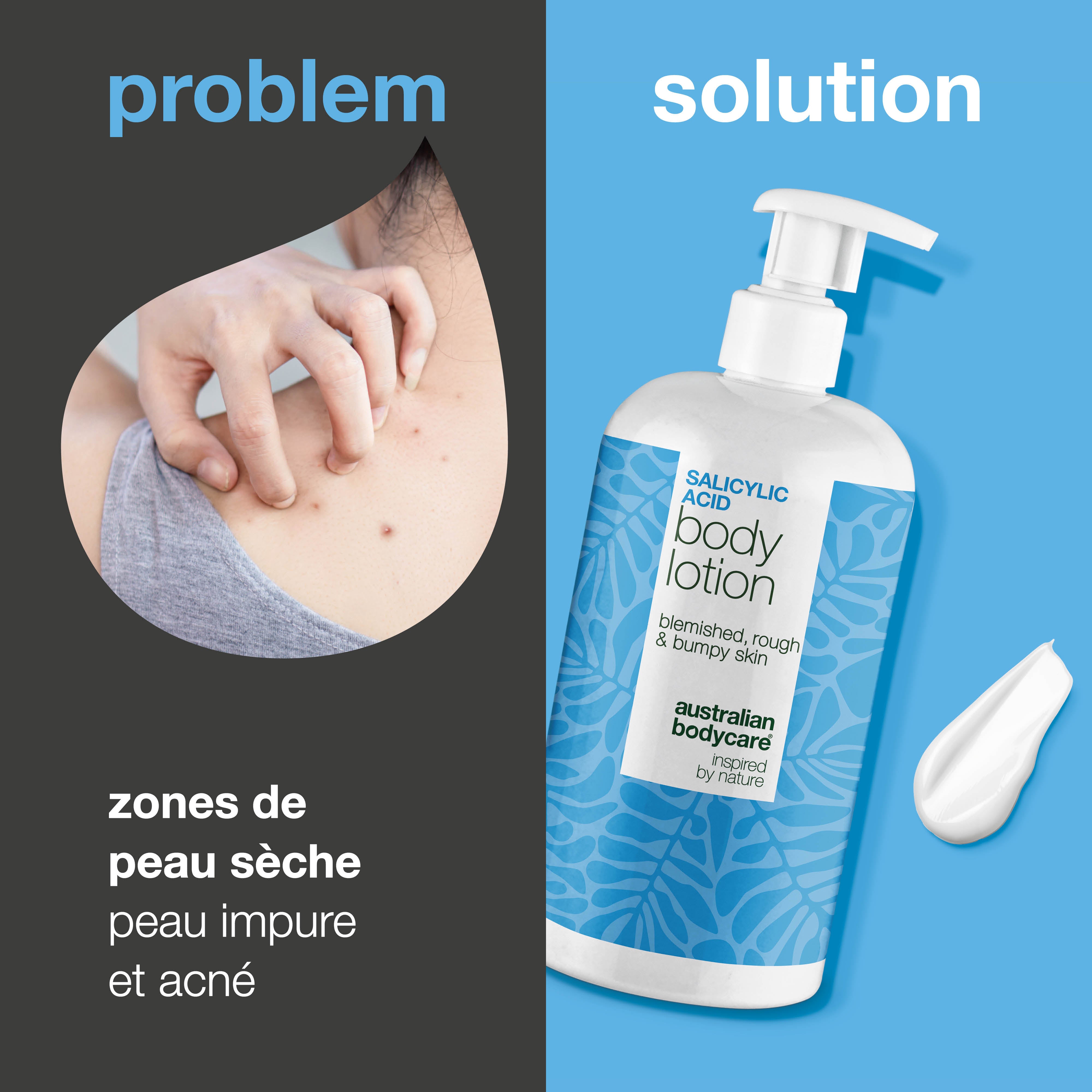 Lotion corps à l’acide salicylique – peau sèche et irrégulière — Lotion à l’acide salicylique qui exfolie, hydrate et aide à lisser la peau sèche et irrégulière. Idéale pour un usage quotidien.