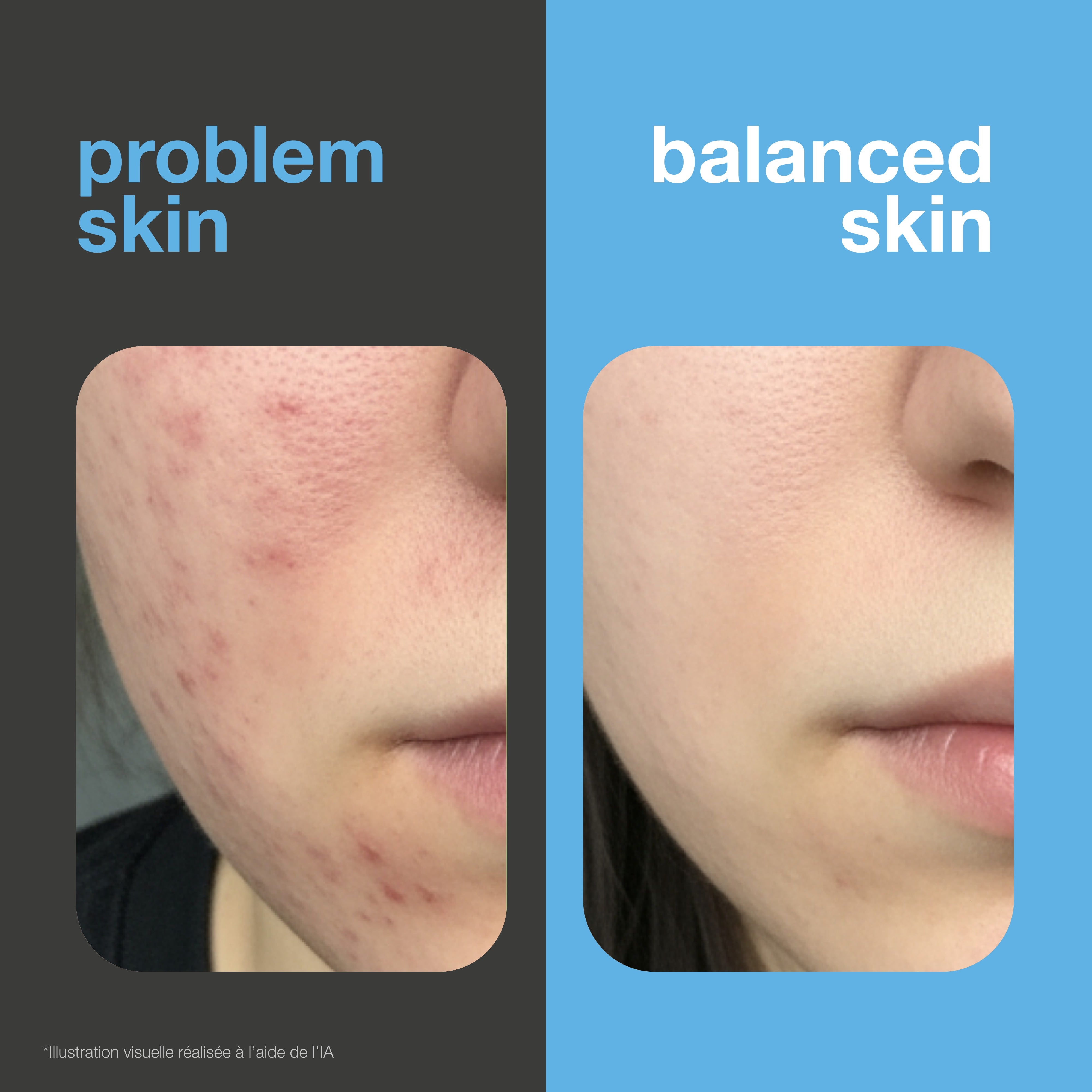 Avant et après : visage avec boutons et rougeurs face à une peau plus nette et plus équilibrée. Illustration visuelle.