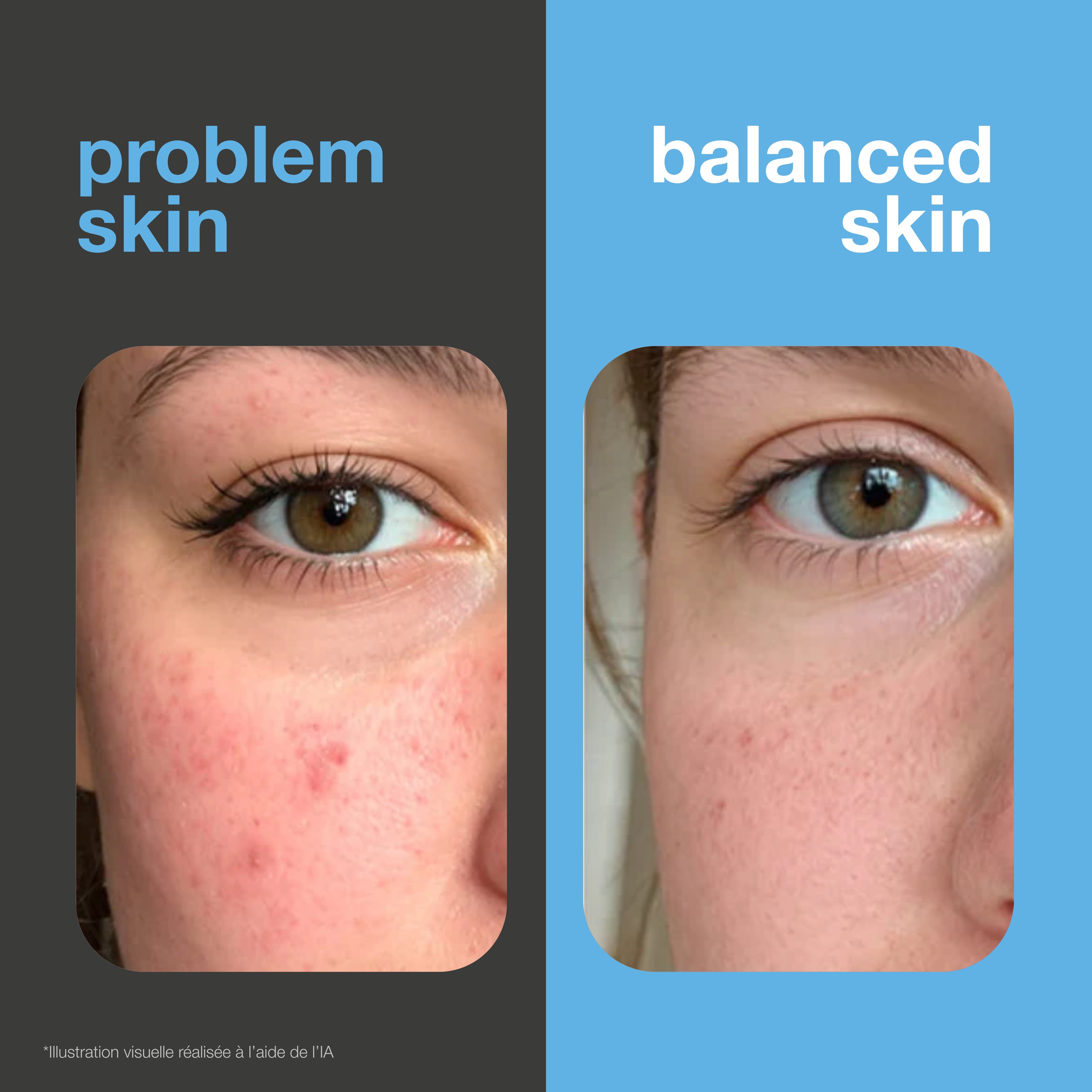 Avant et après : visage avec boutons et rougeurs face à une peau plus nette et plus équilibrée. Illustration visuelle.
