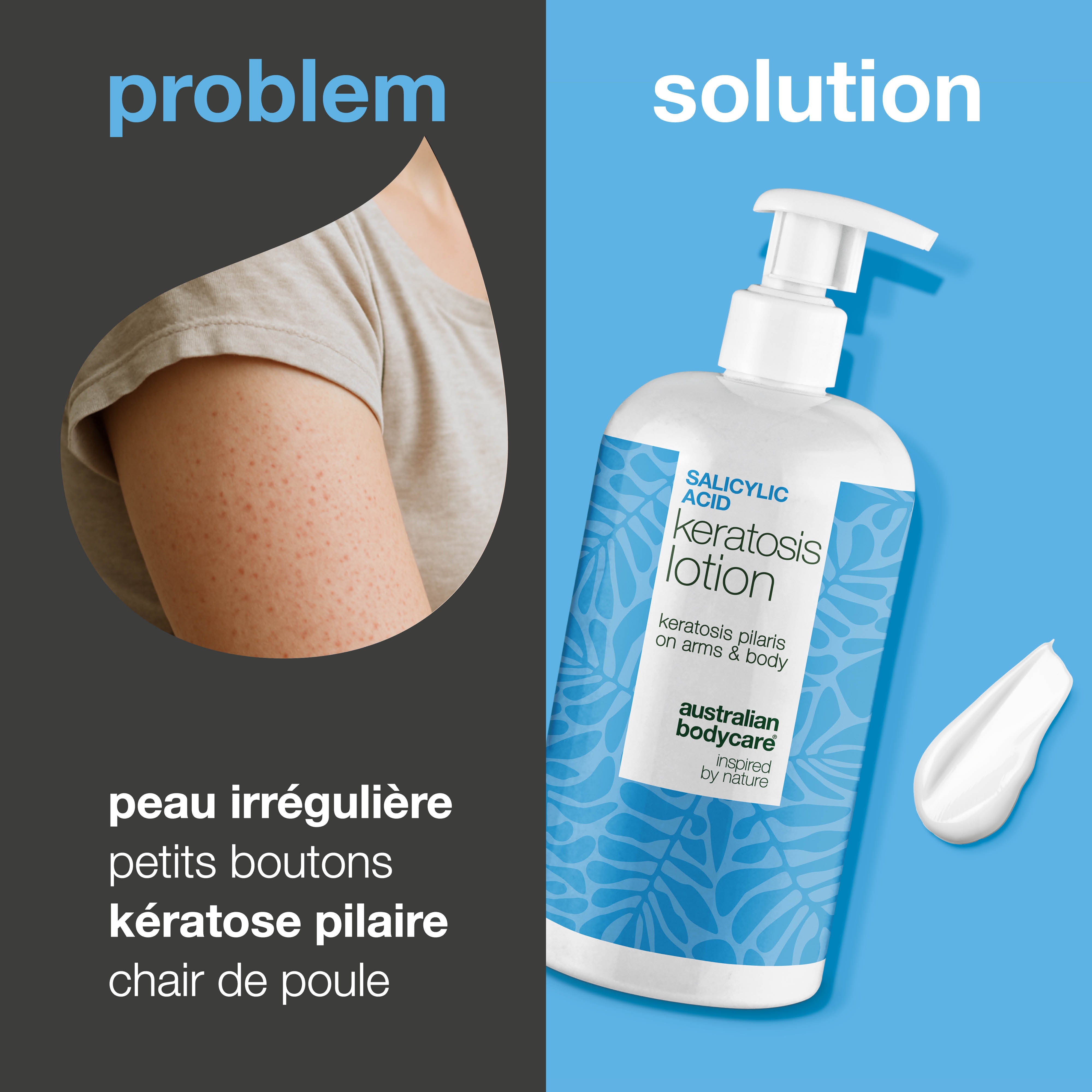 Lotion corps kératose pilaire et peau sèche granuleuse — Lotion pour kératose pilaire et peau sèche. Lisse avec acide salicylique, niacinamide et zinc.