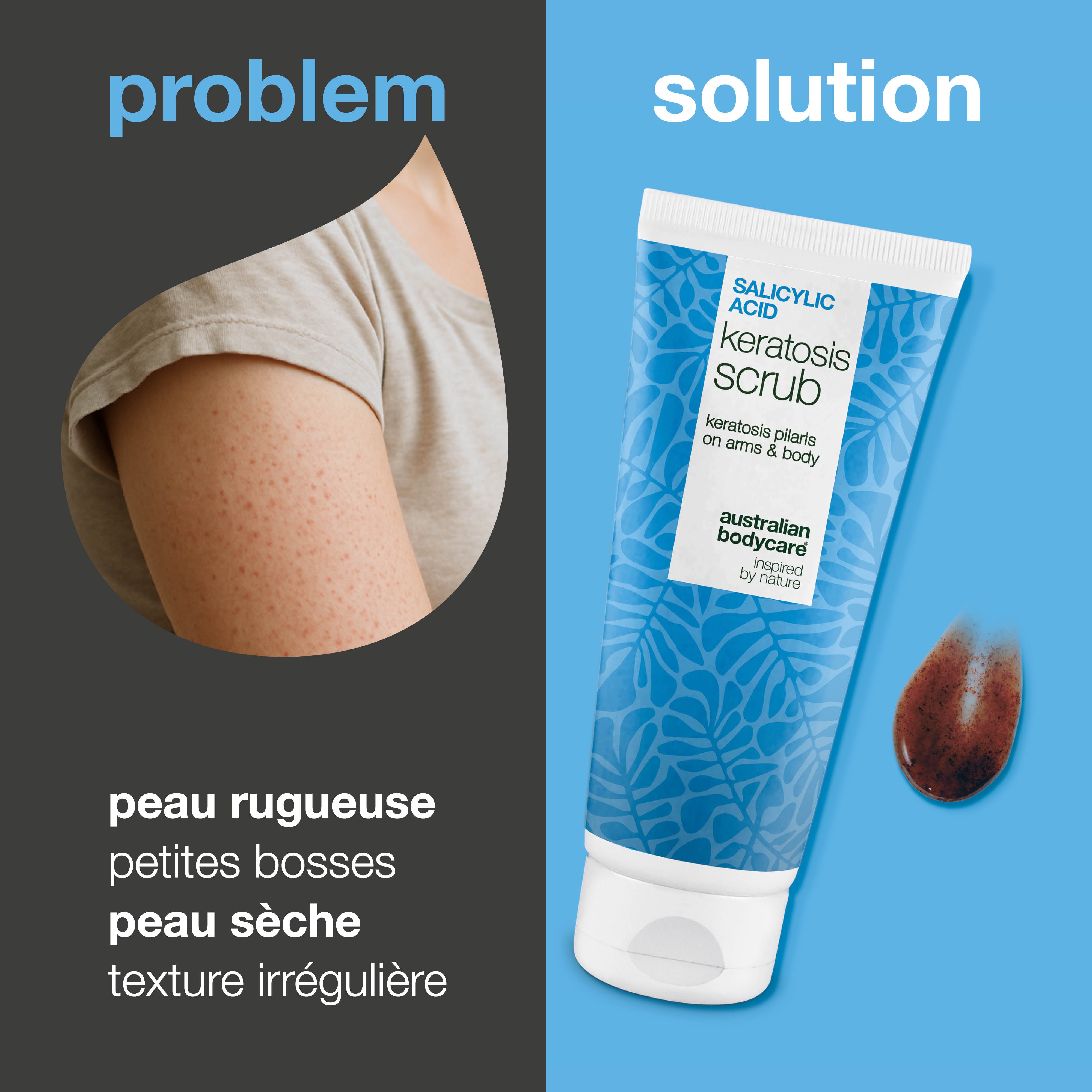 Gommage Corps Keratosis Pilaris élimine les cellules mortes et réduit les bosses. Lisse la peau avec acide salicylique, acide glycolique et allantoïne.