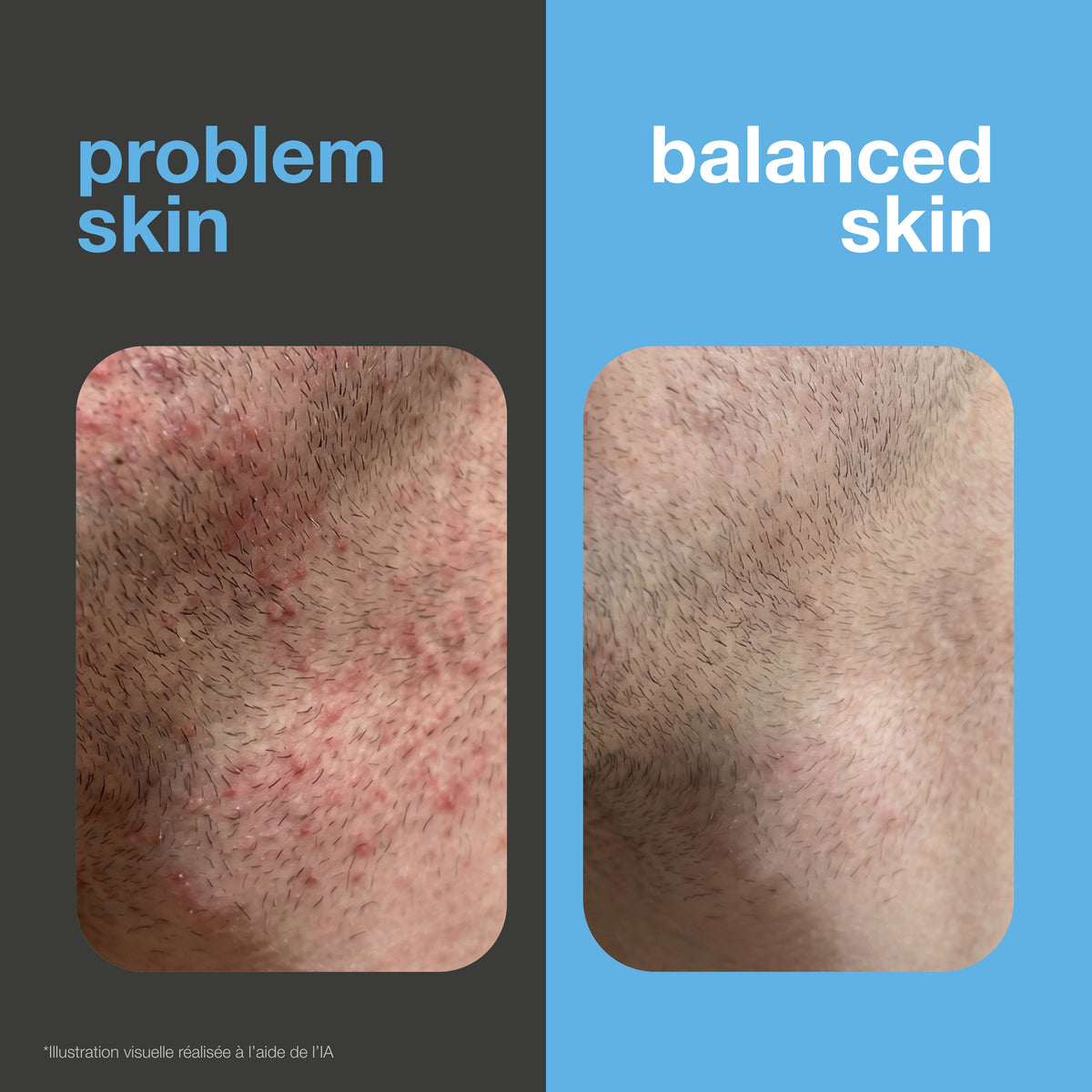 Avant et après : peau rasée avec boutons de rasage et irritations face à une peau lisse et apaisée. Illustration visuelle.