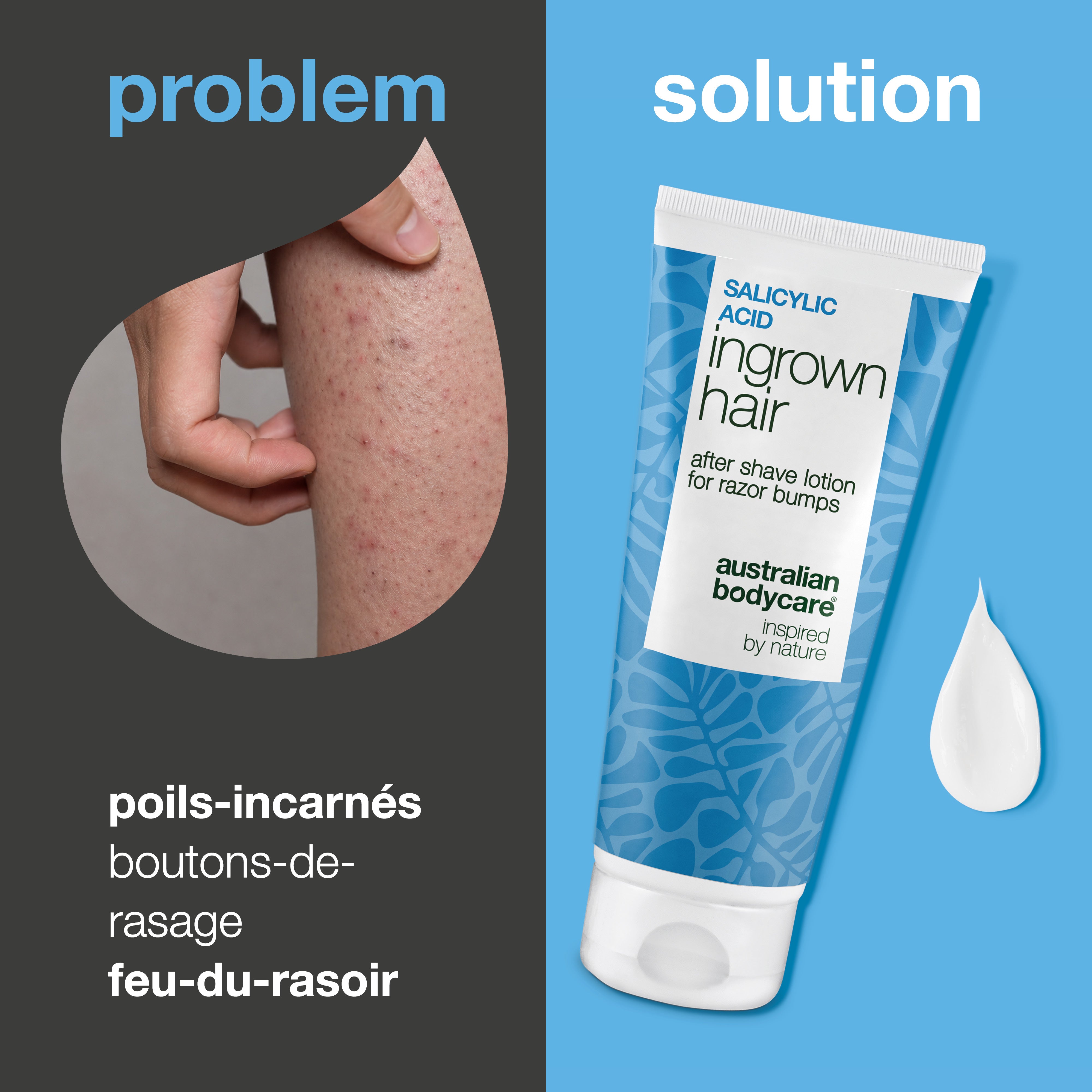 Lotion Après-Rasage à l’Acide Salicylique contre les poils incarnés, les boutons rouges et les irritations dues au rasage. Le produit est présenté à côté d’une zone de peau avec des boutons rouges visibles et des poils incarnés.