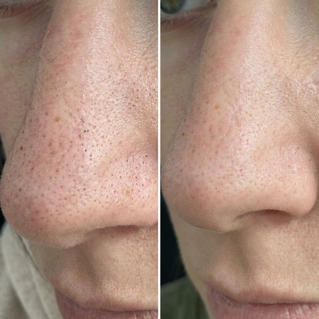 Coffret contre les points noirs et pores obstrués – routine exfoliante à l’acide salicylique pour une peau lisse