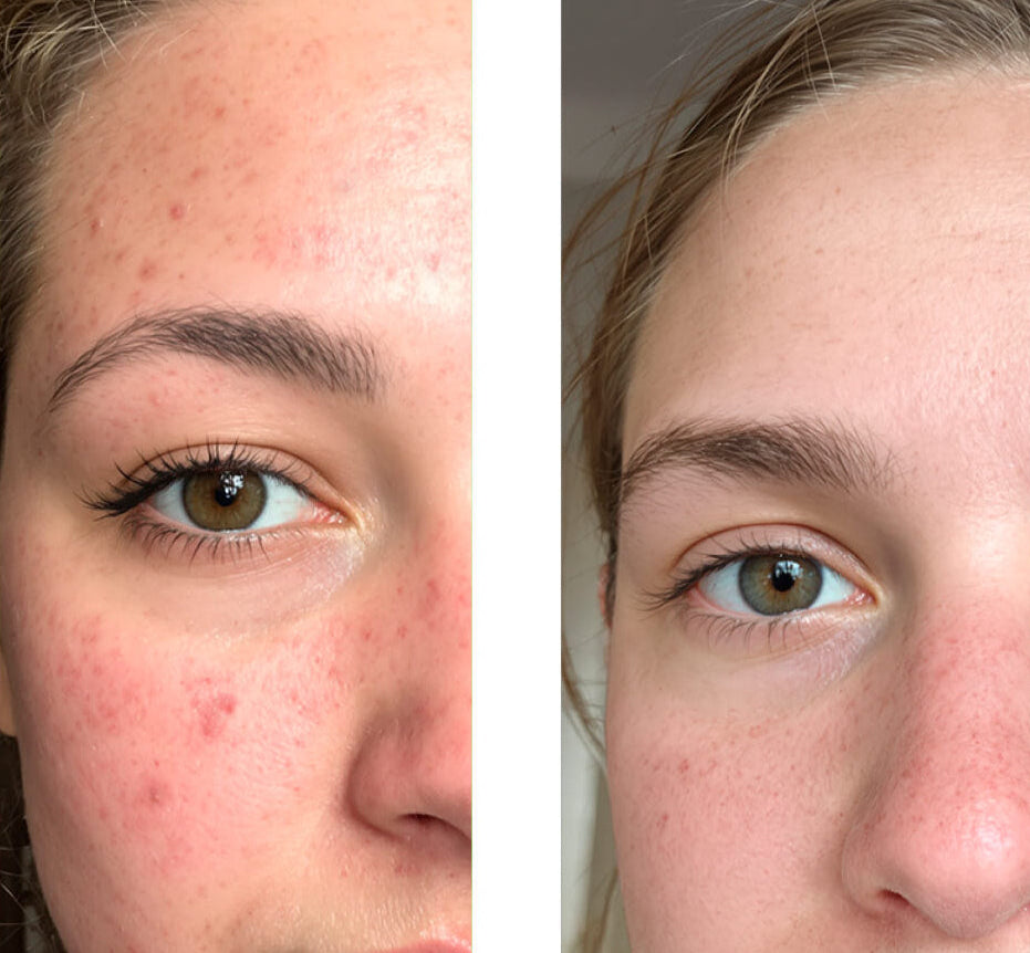 Image avant/après d'un client utilisant notre Tonique/Peeling/Exfoliant visage à l'acide salicylique 2%, montrant une grande amélioration de la peau avec moins de boutons et d'imperfections.