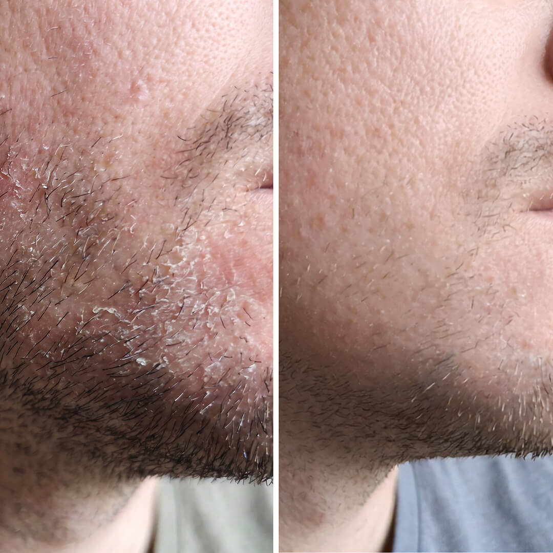 Sérum Acide Salicylique – Pellicules visage, barbe et sourcils — Sérum efficace contre les pellicules du visage et de la barbe. L'Acide Salicylique élimine squames et rougeurs pour une peau équilibrée.