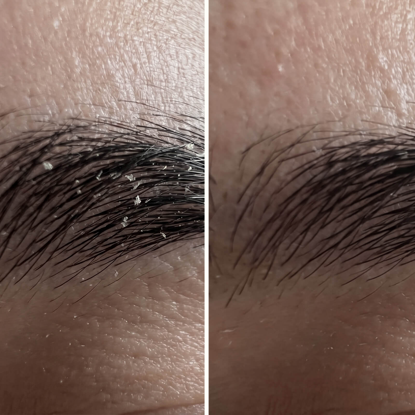 Sérum Acide Salicylique – Pellicules visage, barbe et sourcils — Sérum efficace contre les pellicules du visage et de la barbe. L'Acide Salicylique élimine squames et rougeurs pour une peau équilibrée.