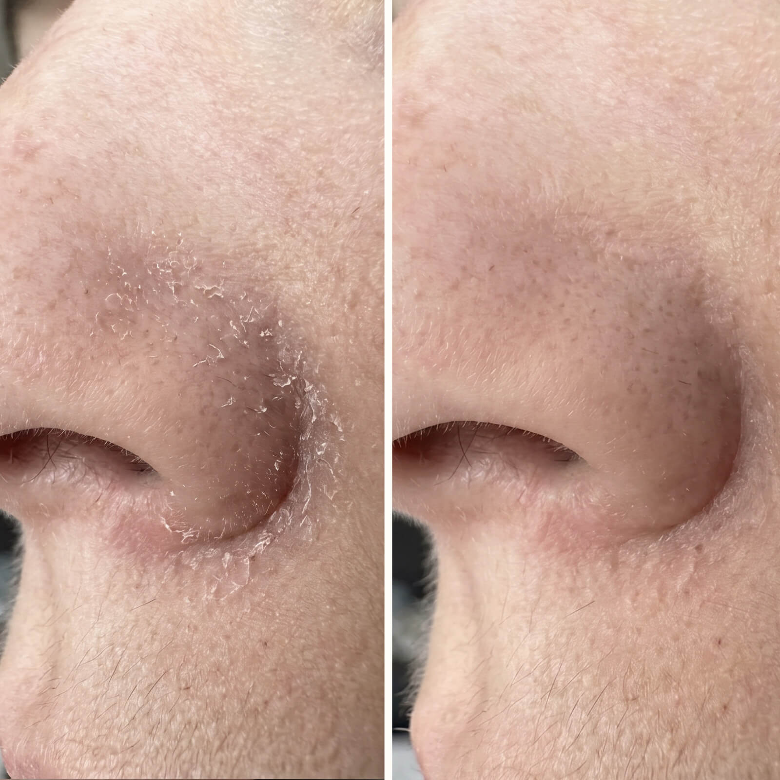 Sérum Acide Salicylique – Pellicules visage, barbe et sourcils — Sérum efficace contre les pellicules du visage et de la barbe. L'Acide Salicylique élimine squames et rougeurs pour une peau équilibrée.