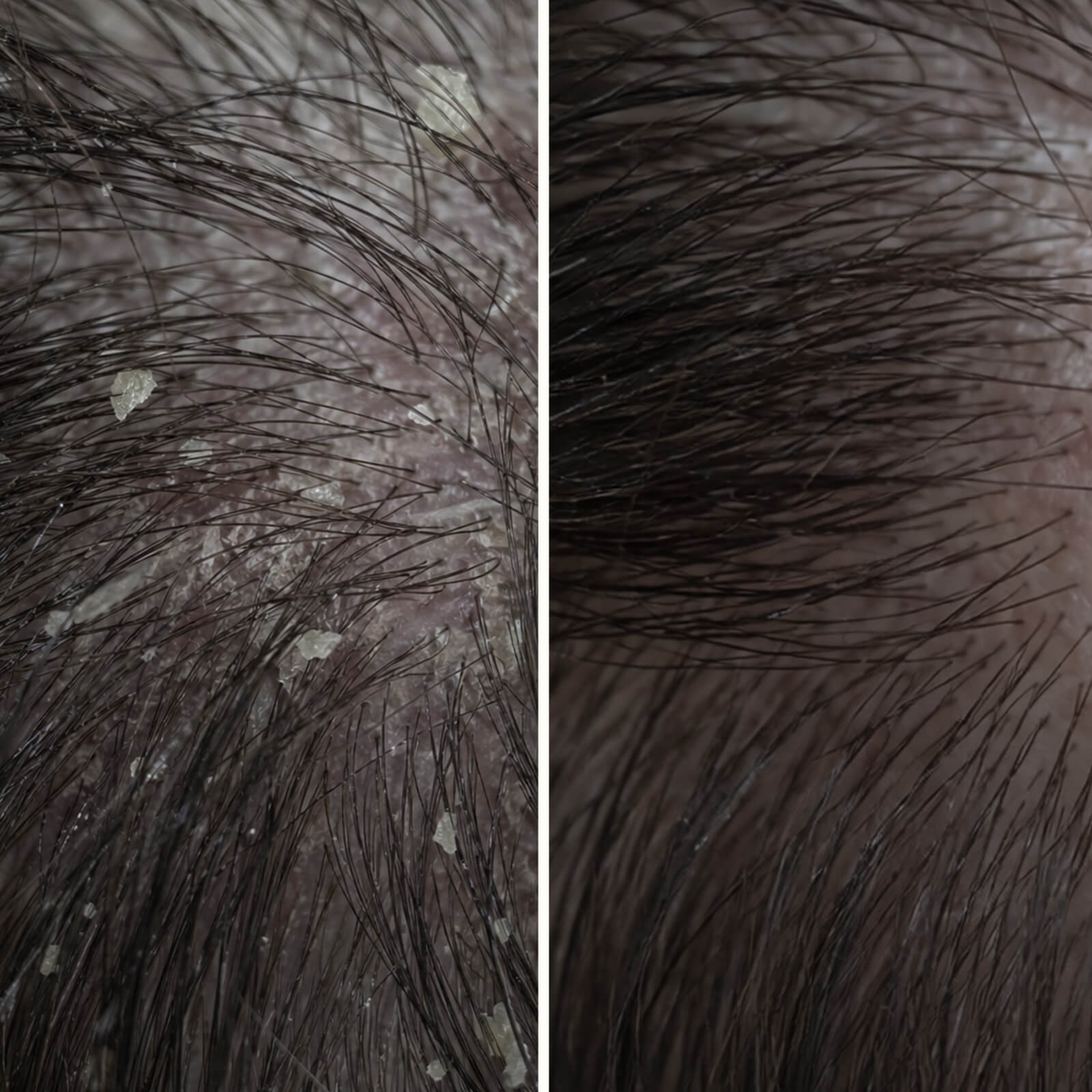 Cure cuir chevelu à l’acide salicylique anti-gras et anti-squames — Le soin à l'acide salicylique calme démangeaisons et pellicules. Avant shampooing pour exfolier à l'acide salicylique.