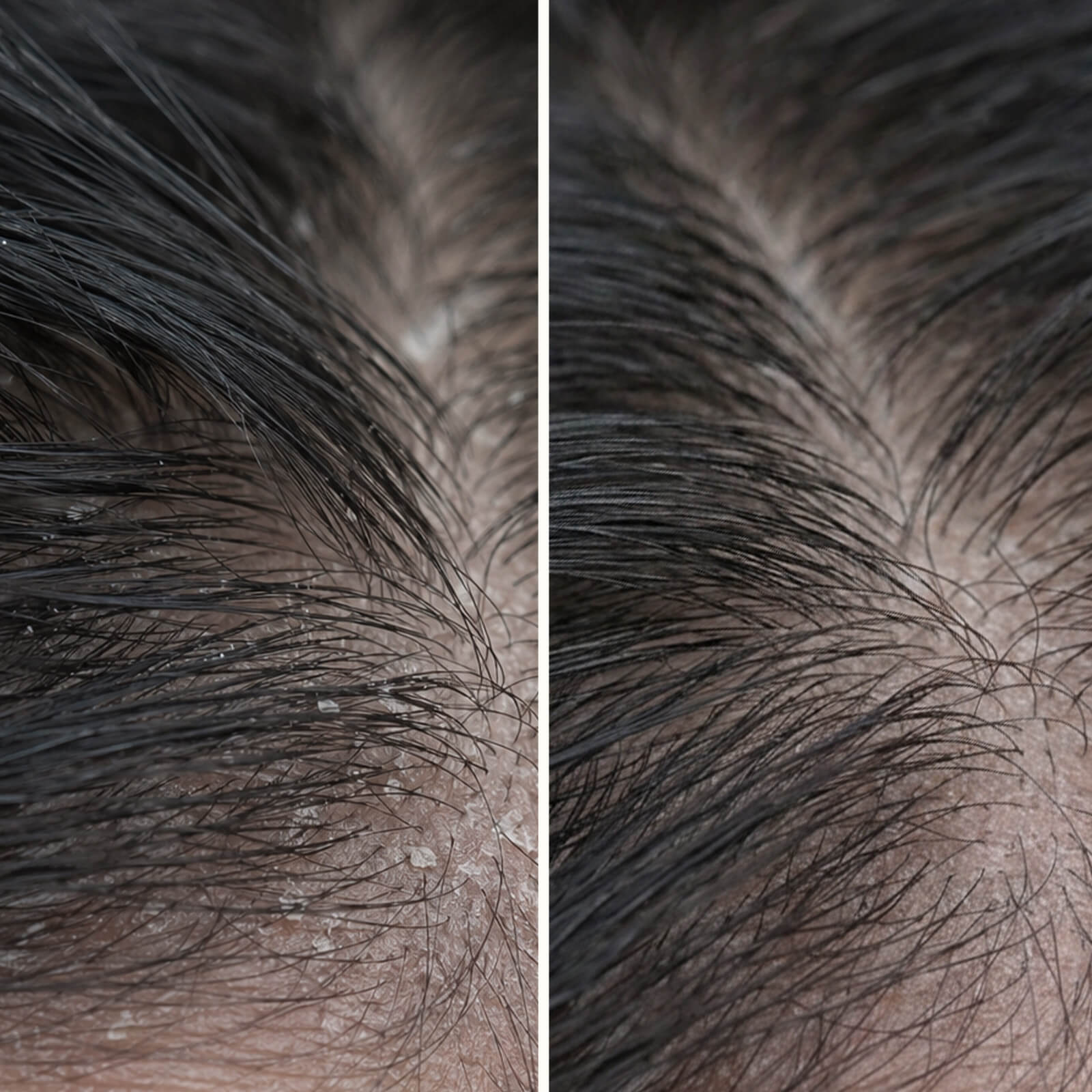 Cure cuir chevelu à l’acide salicylique anti-gras et anti-squames — Le soin à l'acide salicylique calme démangeaisons et pellicules. Avant shampooing pour exfolier à l'acide salicylique.