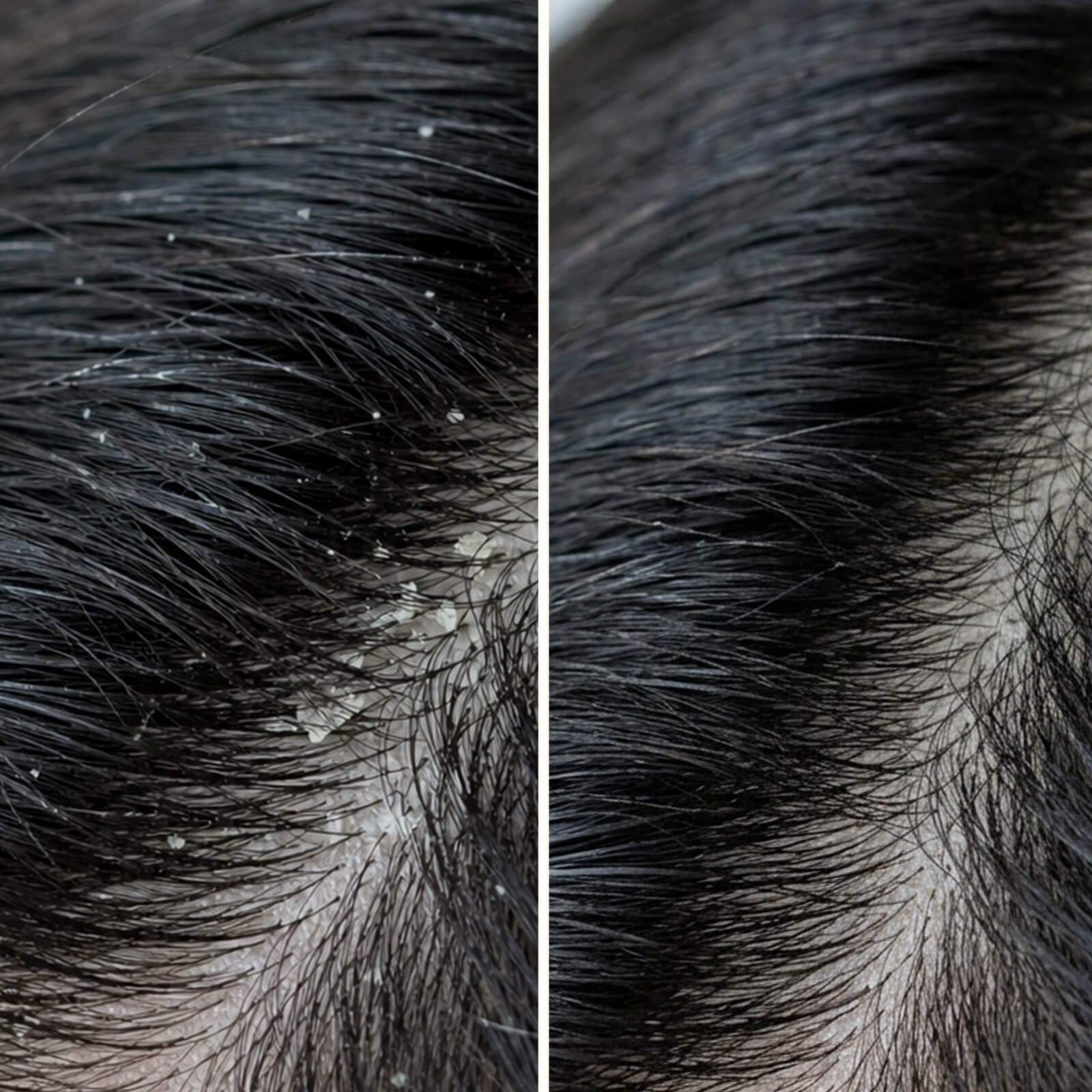 Shampooing Acide Salicylique : Pellicules et Démangeaisons — Dites adieu aux pellicules et au cuir chevelu sec. Ce shampooing exfolie et apaise les irritations avec de l'acide salicylique.