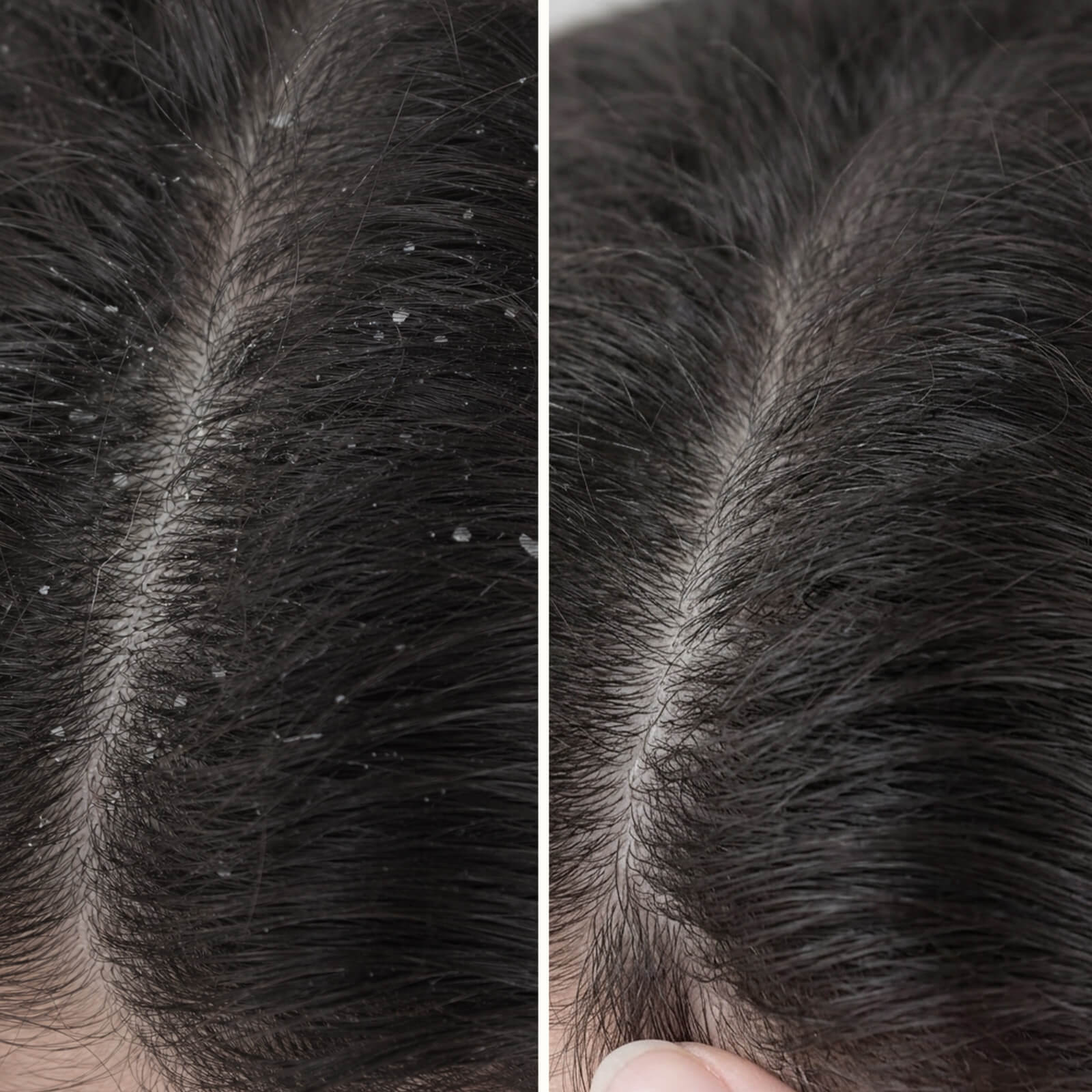 Après-shampooing Acide Salicylique : Pellicules & Démangeaisons — Après-shampooing à l'Acide Salicylique contre les pellicules et irritations. Hydrate et renforce les cheveux. Soin à l'Acide Salicylique.