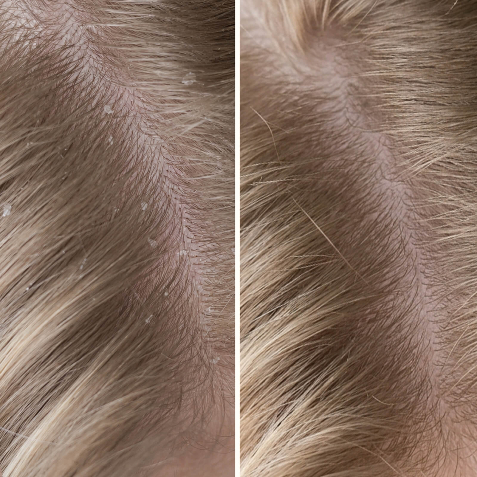 Shampooing Acide Salicylique : Pellicules et Démangeaisons — Dites adieu aux pellicules et au cuir chevelu sec. Ce shampooing exfolie et apaise les irritations avec de l'acide salicylique.