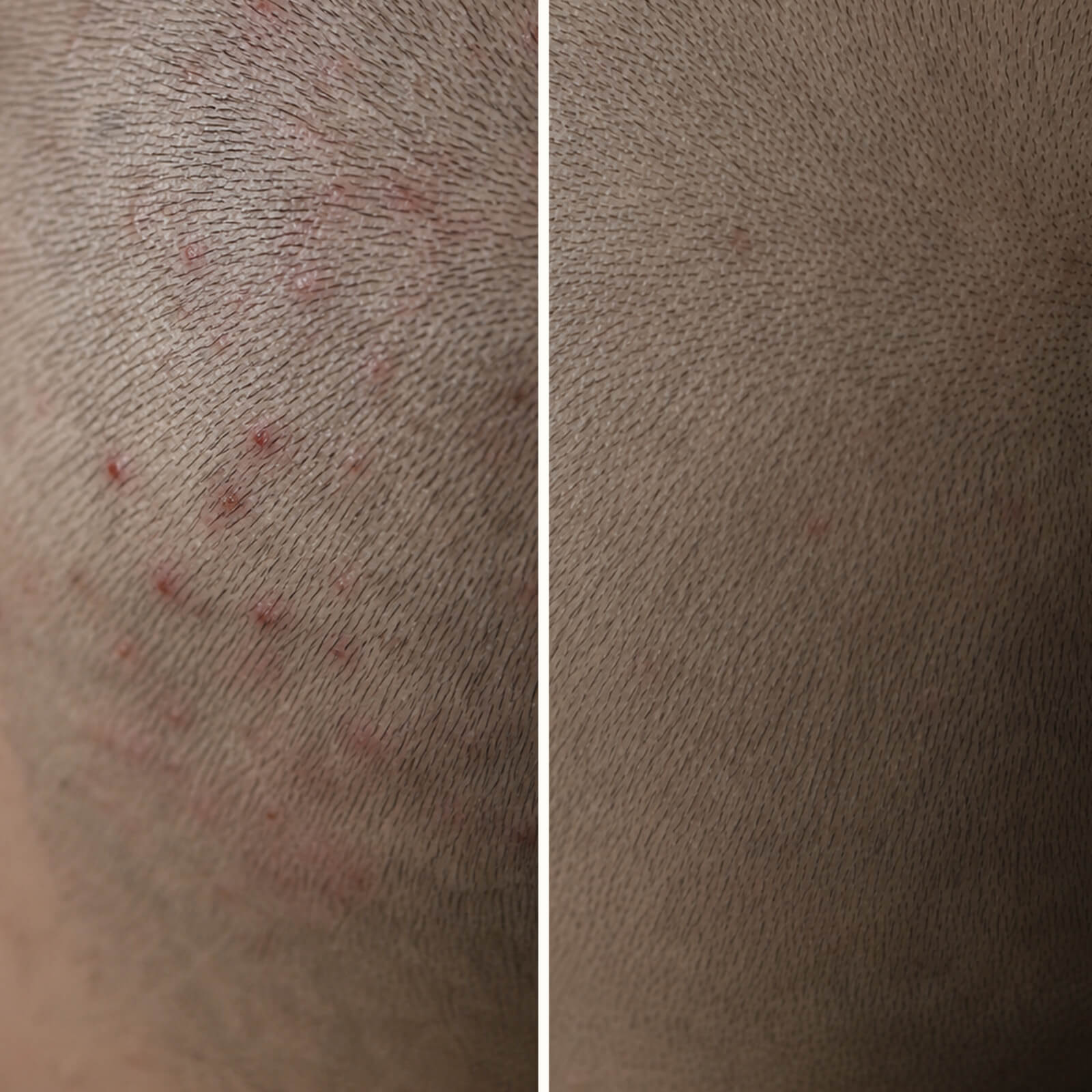Gel Acide Salicylique : Boutons et Cuir Chevelu Irrité — Dites adieu aux boutons sur le cuir chevelu ! L’Acide Salicylique exfolie, purifie et apaise les zones douloureuses et les démangeaisons.