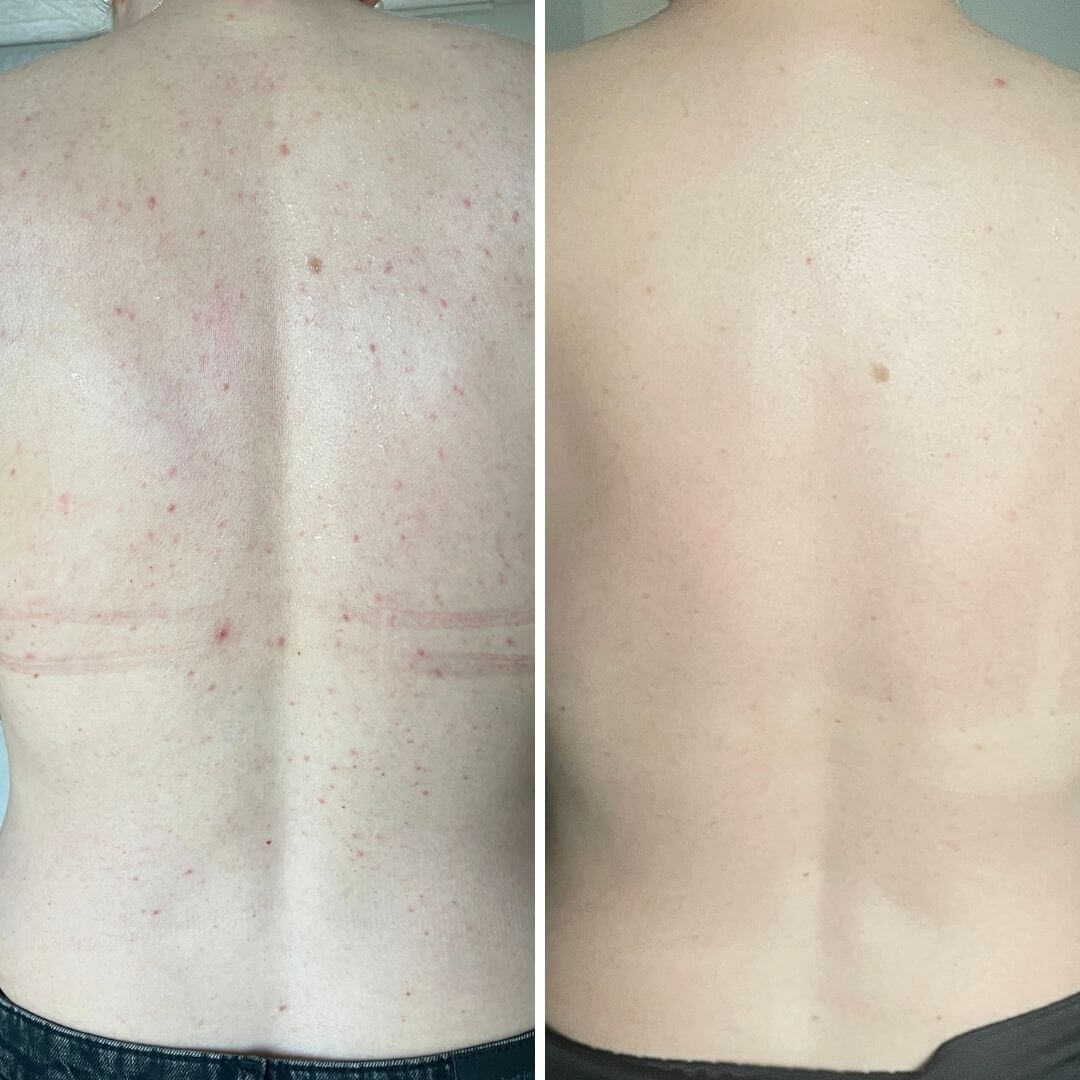 Image avant/après d’un dos avec des boutons et de l’acné sur la photo "avant", puis un dos clair et lisse sans imperfections après 4 semaines d’utilisation régulière du Spray Corporel à l’Acide Salicylique d’Australian Bodycare.