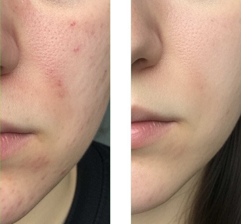 Image avant/après d'un client utilisant notre nettoyant à l'acide salicylique (Salicylic Acid Cleanser), montrant une grande amélioration de la peau avec moins de boutons et d'imperfections.