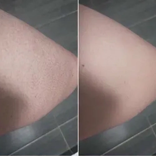 Kératose pilaire avant et après d'Alena – peau plus lisse après 2 semaines