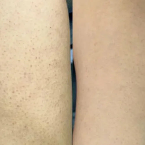 Résultat d'Isabell avec le kit kératose pilaire – réduction des boutons sur les cuisses